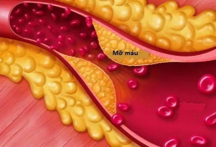 Mỡ máu gây ra các bệnh tim mạch nguy hiểm (Ảnh: Internet). Mỡ máu gây ra các bệnh tim mạch nguy hiểm (Ảnh: Internet).