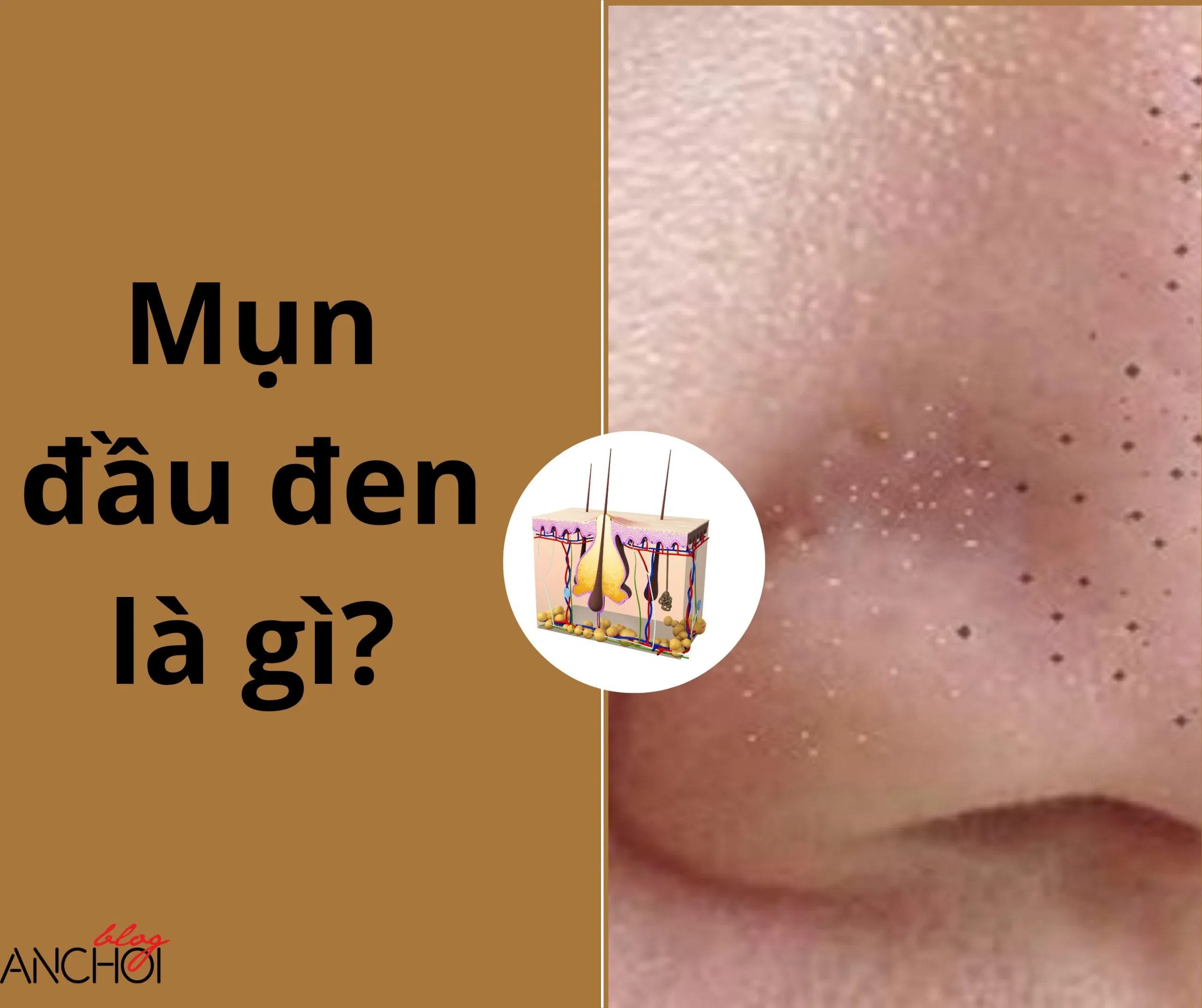 Mụn đầu đen là một dạng mụn trứng nhưng không gây viêm ( Nguồn: BlogAnChoi)