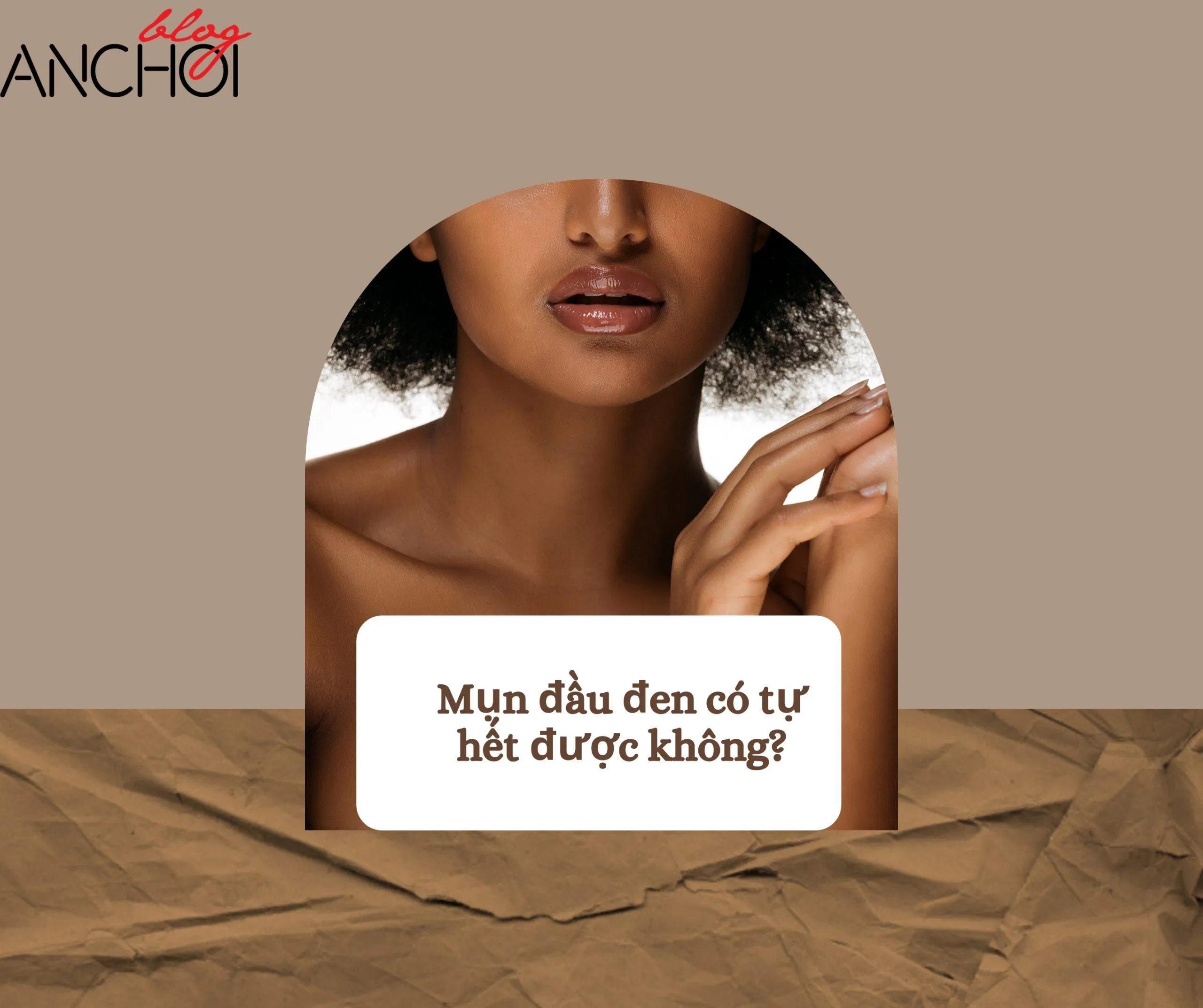 Mụn đầu đen càng để lâu ngày sẽ có nguy cơ hình thành các nốt mụn sưng viêm và khó điều trị hơn ( Nguồn: BlogAnChoi)