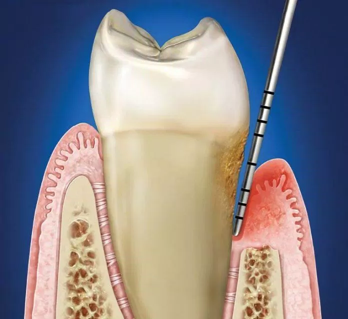 Dùng đầu dò để đo khoảng trống giữa răng và nướu (Ảnh: Internet).