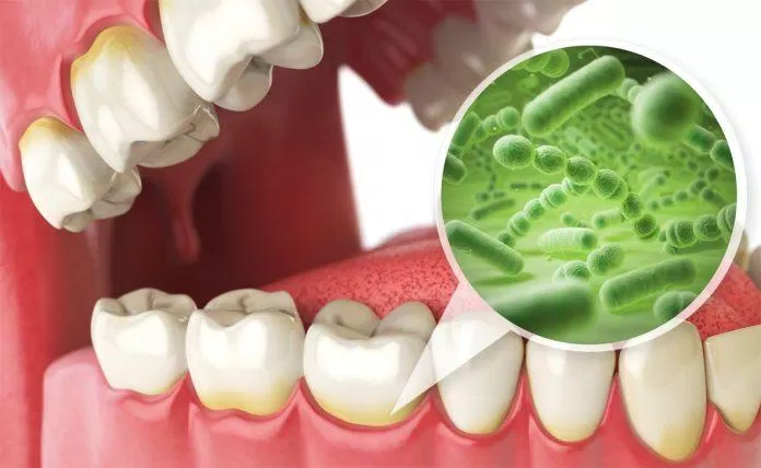 Vi khuẩn là nguyên nhân gây các bệnh răng miệng (Ảnh: Internet).