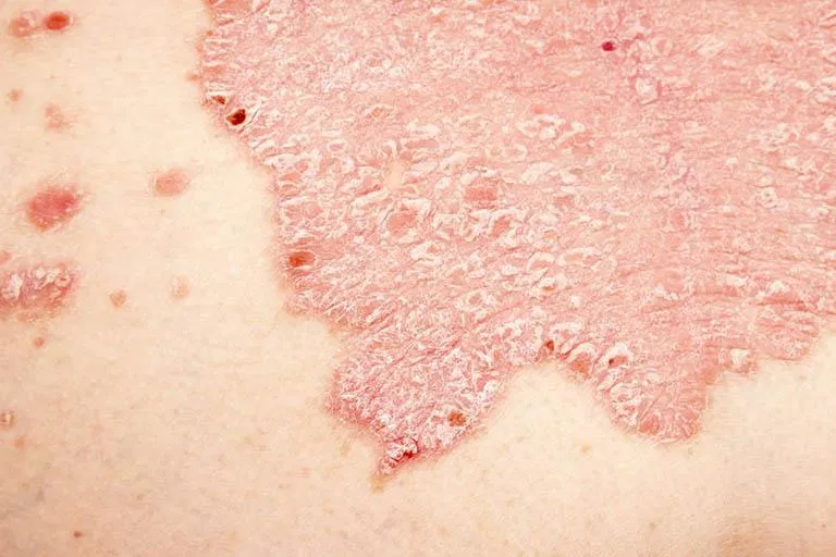 Bệnh vảy nến dạng mảng (Nguồn: Internet).