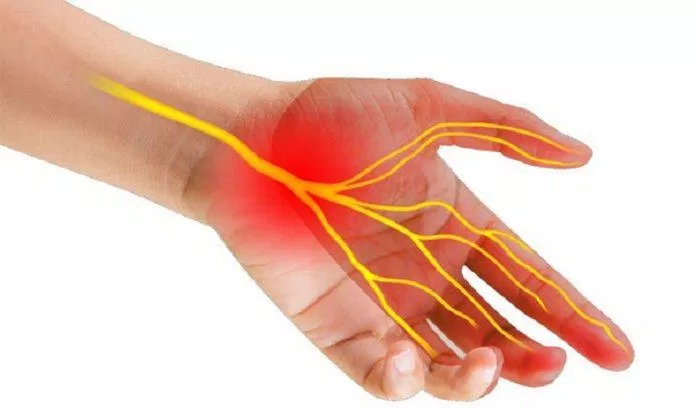 Hội chứng ống cổ tay là do dây thần kinh bị chèn ép khi đi qua cổ tay (Ảnh: Internet).