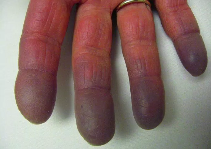 Hội chứng Raynaud ở ngón tay (Ảnh: Internet).