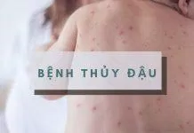 Bệnh thủy đậu