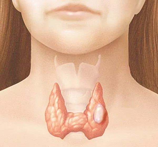 Bướu giáp có thể lành tính hoặc ác tính (Ảnh: Internet). Bướu giáp có thể lành tính hoặc ác tính (Ảnh: Internet).