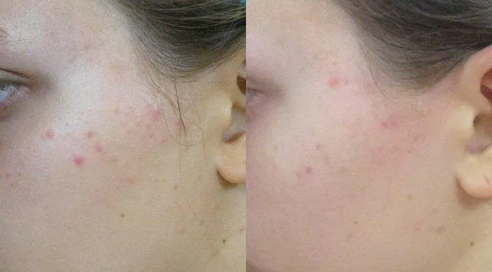 Trước và sau khi sử dụng kem dưỡng SVR SEBIACLEAR Mat + Pores