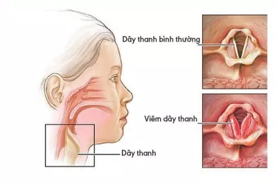 Viêm thanh quản làm cho dây thanh âm sưng phù (Ảnh: Internet). Viêm thanh quản làm cho dây thanh âm sưng phù (Ảnh: Internet).