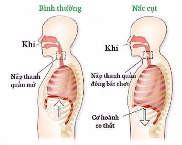 Cơ chế gây ra tiếng nấc (Ảnh: Internet).