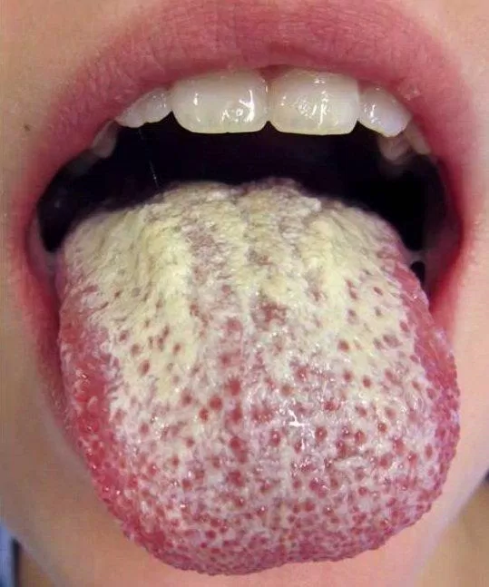 Lưỡi trắng do nhiễm nấm Candida (Ảnh: Internet).