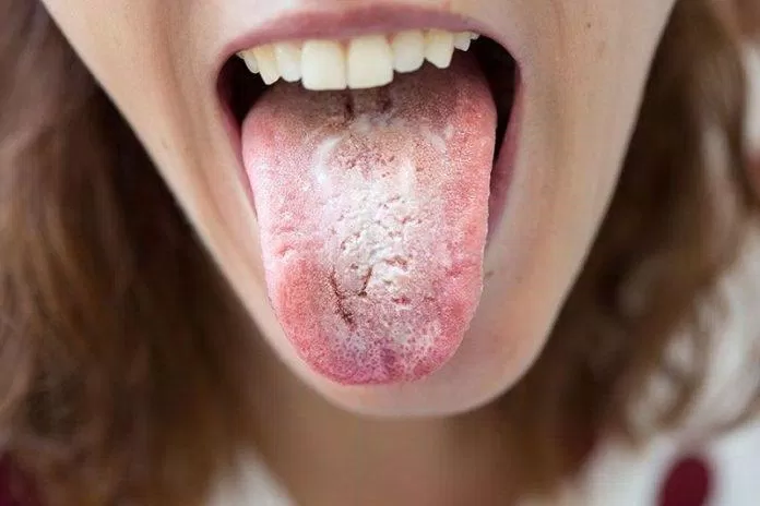 Bệnh tưa miệng có thể lây lan sang các bộ phận khác trên cơ thể (Ảnh: Internet).