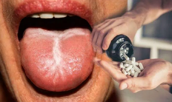 Lưỡi bị đỏ do thiếu axit folic (Ảnh: Internet). Lưỡi bị đỏ do thiếu axit folic (Ảnh: Internet).