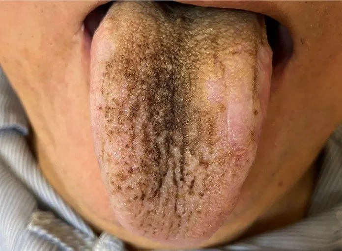 Lưỡi đen sau khi dùng thuốc kháng sinh (Ảnh: Internet).