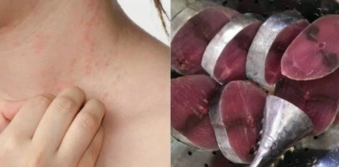 Ăn nhiều cá ngừ có nguy cơ bị ngộ độc thuỷ ngân. (Ảnh: Internet) Ăn nhiều cá ngừ có nguy cơ bị ngộ độc thuỷ ngân. (Ảnh: Internet)