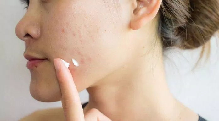 Sử dụng sản phẩm đặc trị để giúp làn da được sạch mụn (Nguồn: Internet)