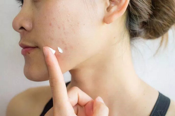 Utilisez des produits spéciaux pour aider à éliminer l'acné de la peau (Source : Internet)
