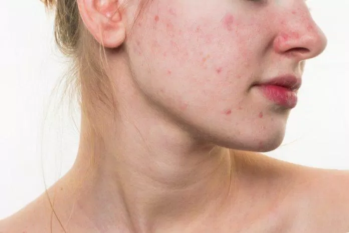 Nettoyer soigneusement la peau pour éliminer les agents responsables de l'acné et réduire l'excès de sébum (Source : Internet)