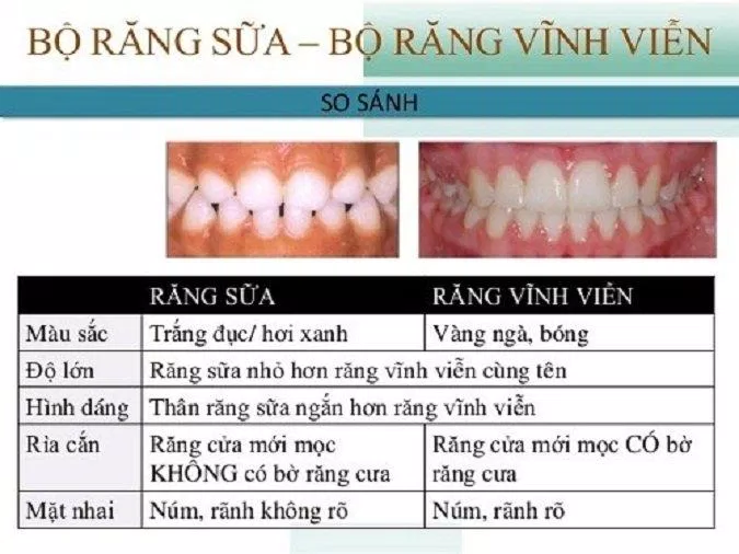 Răng sữa ảnh hưởng rất nhiều đến răng vĩnh viễn sau này (Ảnh: Internet).