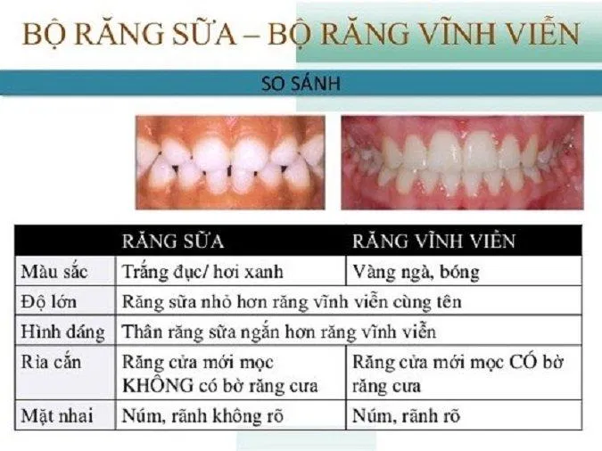 Răng sữa ảnh hưởng rất nhiều đến răng vĩnh viễn sau này (Ảnh: Internet). Răng sữa ảnh hưởng rất nhiều đến răng vĩnh viễn sau này (Ảnh: Internet).