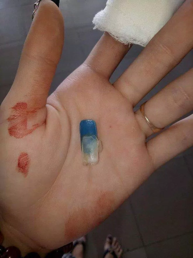 Hậu quả của việc tự ý cắt móng tay (Nguồn: Internet)