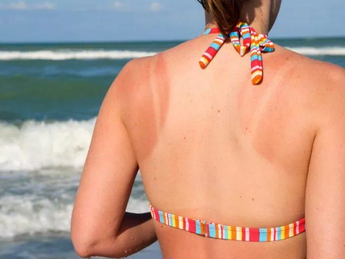 Làn da rám nắng có thể đi kèm với nguy cơ ung thư da (Ảnh: Internet).