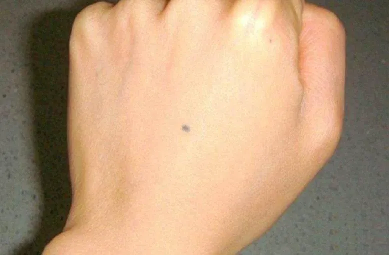 Không xăm lên nốt ruồi (Ảnh: Internet). Không xăm lên nốt ruồi (Ảnh: Internet).