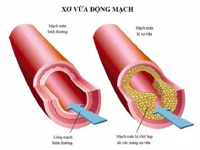 Xơ vữa động mạch làm cho mạch máu bị hẹp lại (Ảnh: Internet). Xơ vữa động mạch làm cho mạch máu bị hẹp lại (Ảnh: Internet).