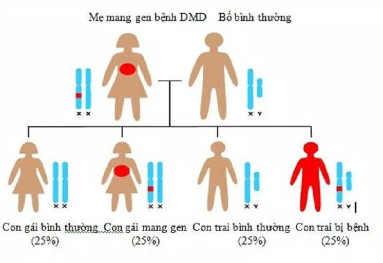 Gene gây bệnh nằm trên nhiễm sắc thể giới tính X (Ảnh: Internet).