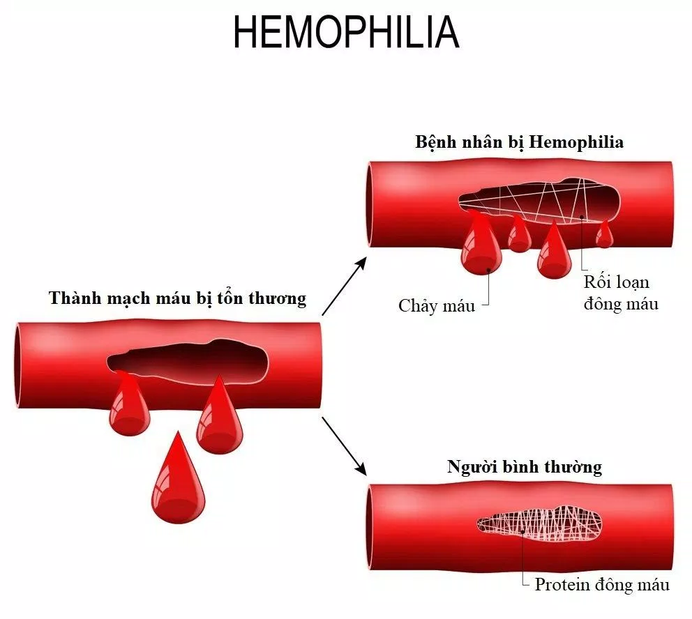 Bệnh hemophilia làm cơ thể khó cầm máu (Ảnh: Internet).