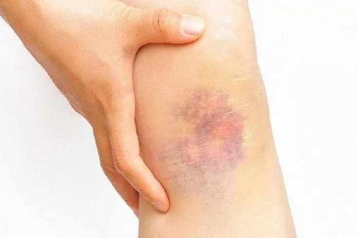 Người thiếu vitamin K thường xuất hiện vết bầm tím dù chỉ va chạm nhẹ (Ảnh: Internet). Người thiếu vitamin K thường xuất hiện vết bầm tím dù chỉ va chạm nhẹ (Ảnh: Internet).