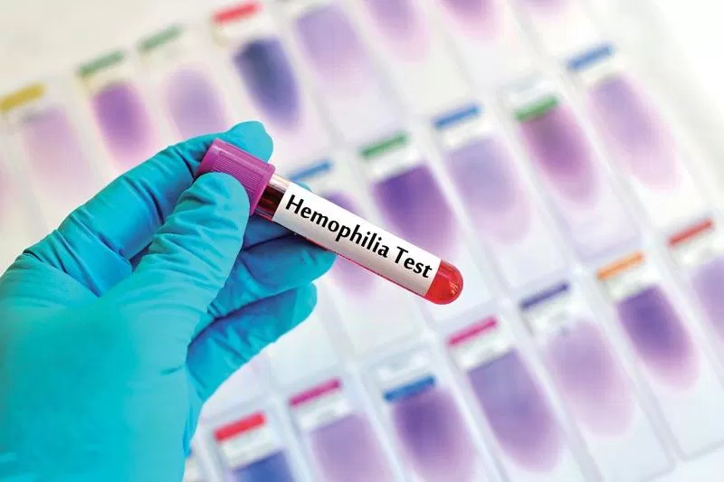 Xét nghiệm máu có thể biết chính xác bệnh hemophilia (Ảnh: Internet).