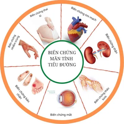 Tiểu đường gây nhiều biến chứng khi bệnh nặng (Nguồn: Internet)