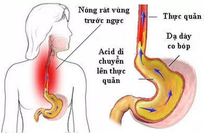 Bệnh trào ngược dạ dày thực quản thường gây ợ nóng (Ảnh: Internet). Bệnh trào ngược dạ dày thực quản thường gây ợ nóng (Ảnh: Internet).