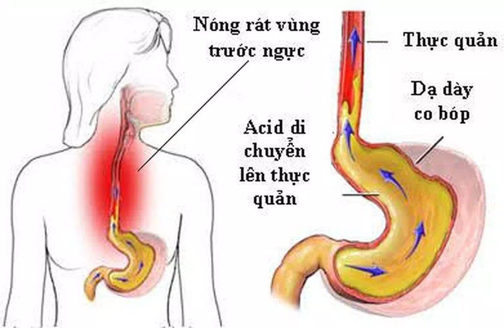 Bệnh trào ngược dạ dày thực quản thường gây ợ nóng (Ảnh: Internet).