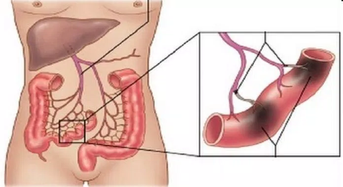 Mạch máu ở ruột có vai trò rất quan trọng (Ảnh: Internet). Mạch máu ở ruột có vai trò rất quan trọng (Ảnh: Internet).