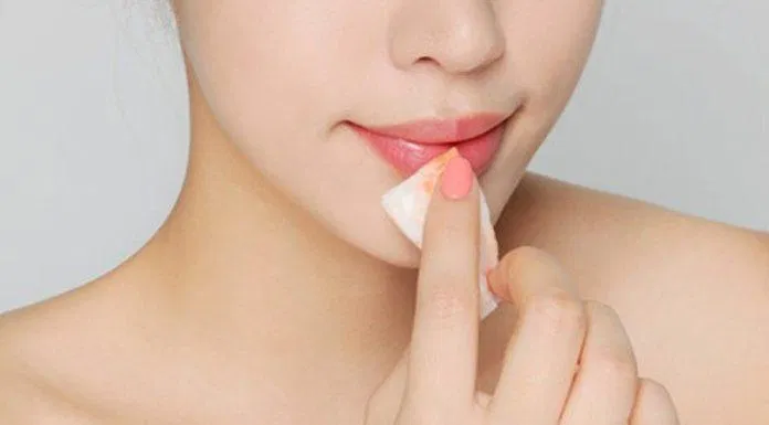 Dùng bông thấm nước để chà dọc theo viền môi chết (Nguồn: Internet)
