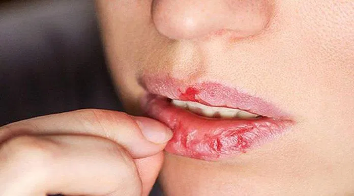 Môi bị khô nứt không nên tẩy tế nào chết liền (Nguồn: internet)