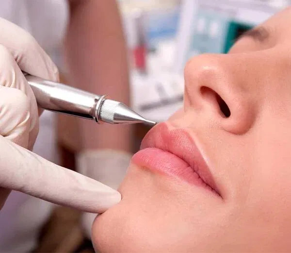 Khử thâm môi bằng Laser CO2 Fractional ( Nguồn: Internet )