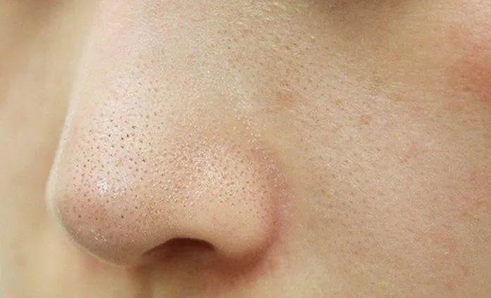 Ảnh minh hoạ mụn cám (mụn đầu trắng) (Ảnh: Internet).