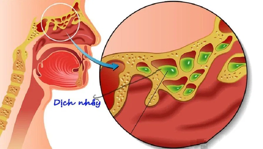 Dịch nhầy được tạo ra từ các xoang nằm bên trong xương mặt (Ảnh: Internet). Dịch nhầy được tạo ra từ các xoang nằm bên trong xương mặt (Ảnh: Internet).