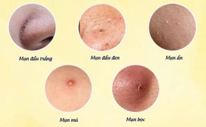 Hình ảnh các loại mụn thường thấy trên da (Ảnh: Internet).
