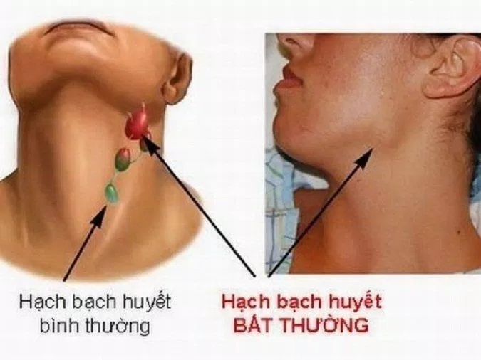 Lymphoma làm cho hạch bạch huyết sưng to (Ảnh: Internet).