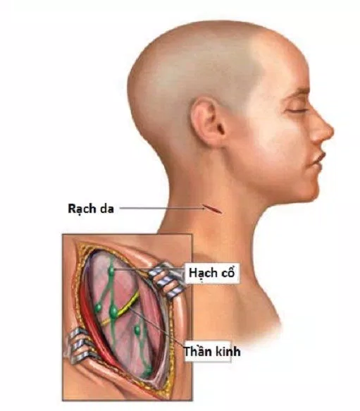 Sinh thiết hạch ở bệnh nhân lymphoma (Ảnh: Internet).