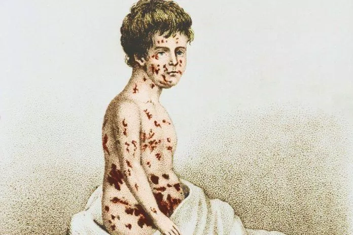 Hình minh họa của một người bị bệnh đậu mùa (Ảnh: Internet).