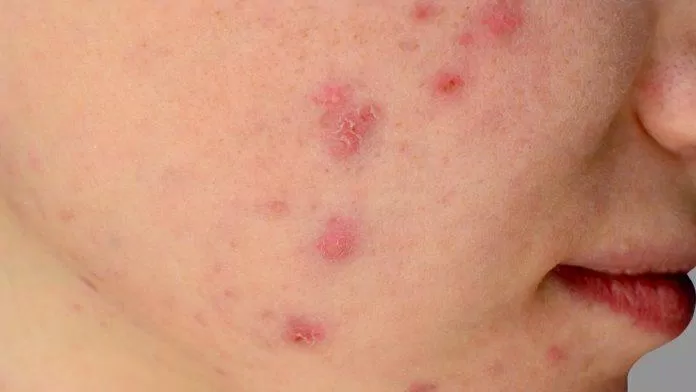 La trétinoïne aide à traiter l'acné plus efficacement aujourd'hui (Source : Internet)