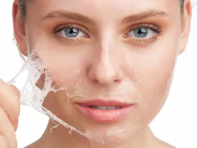 Bên cạnh laser, tàn nhang cũng có thể điều trị bằng sử dụng phương pháp peel da. (Nguồn: Internet)