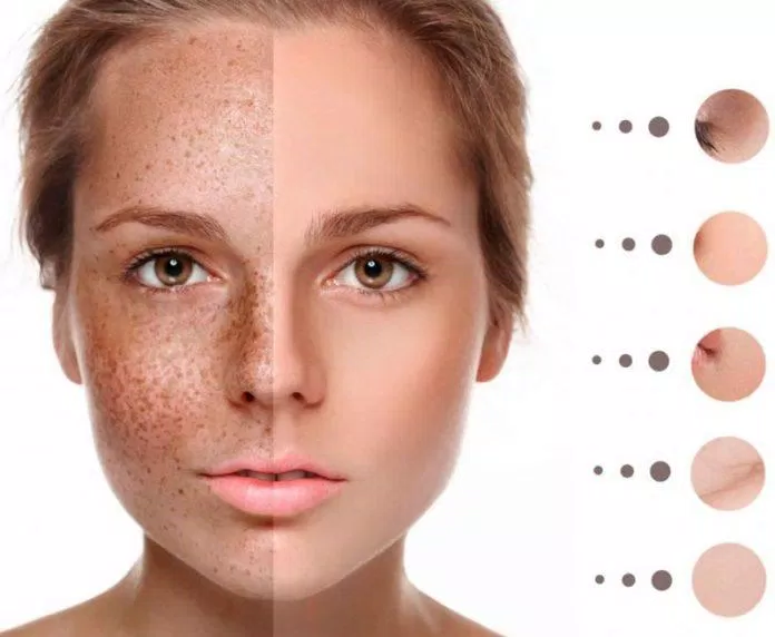Tàn nhang là một tình trạng tăng sắc tố da khá phổ biến (Nguồn: Internet)