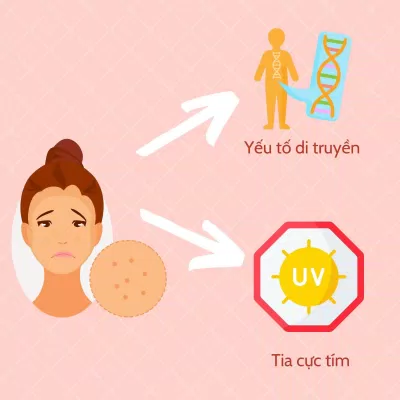 Nguyên nhân chính gây nên tình trạng tàn nhang. (Nguồn: BLogAnChoi)