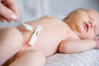 Quá trình rụng rốn của trẻ sơ sinh (Nguồn Internet)