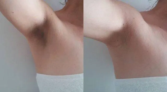 Sử dụng lăn nách quá thường xuyên cũng là nguyên nhân khiến da bị thâm đen (Nguồn: Internet)